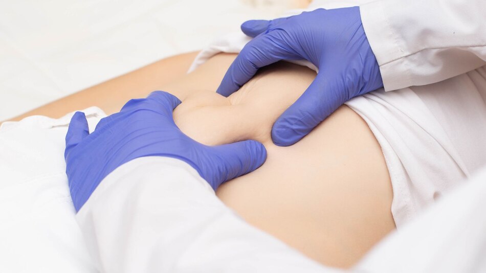 Cirugía mínimamente invasiva para eliminar hernias abdominales. Menor dolor y tiempo de recuperación