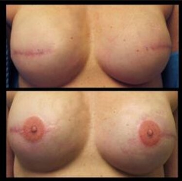 Se ofrecen tatuajes de pezón y areola a sobrevivientes de cáncer de mama