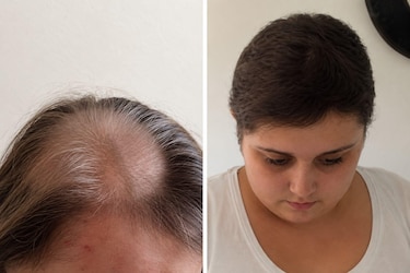 Recibí quimioterapia durante 11 años por un cáncer que no tenía