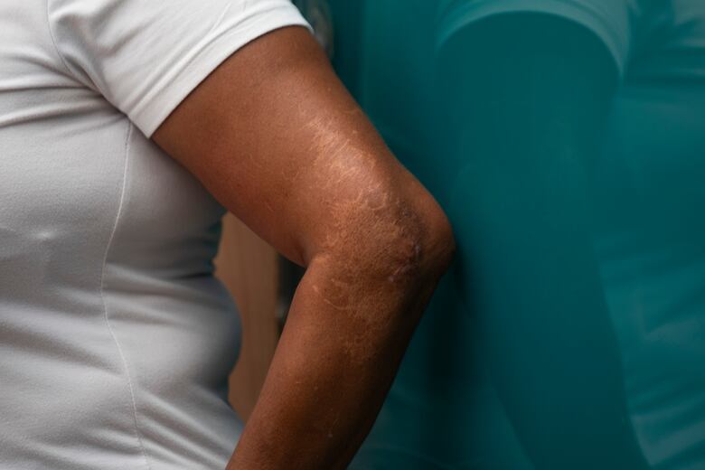 Entre el abandono y el dolor: sobrevivientes de atropellos por metrobús exigen justicia