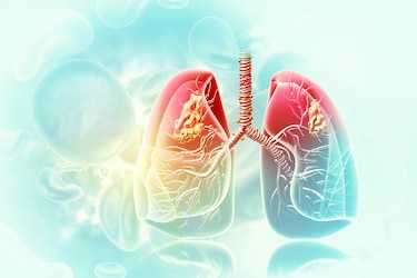 Una alianza para luchar contra el cáncer de pulmón