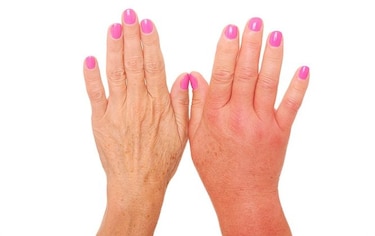 Angioedema hereditario, una enfermedad poco conocida