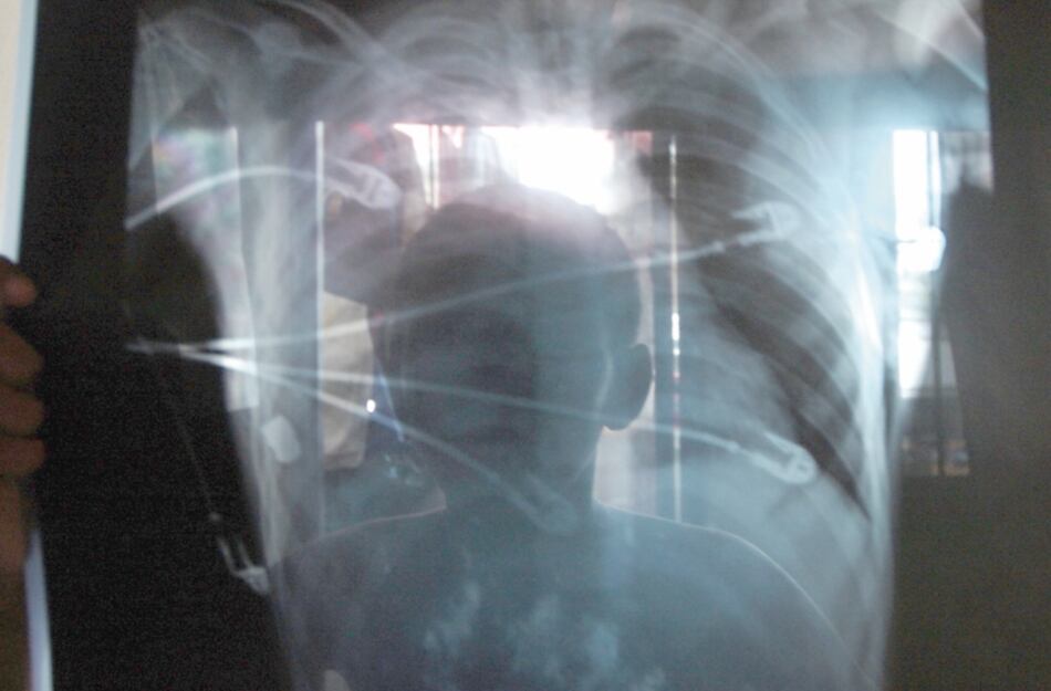 Radiólogos advierten de dificultades para recibir los insumos de protección