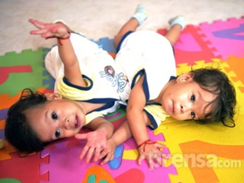 Separadas con éxito siamesas de un año de edad