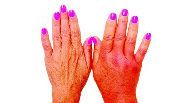 Huellas del angioedema, un mal raro
