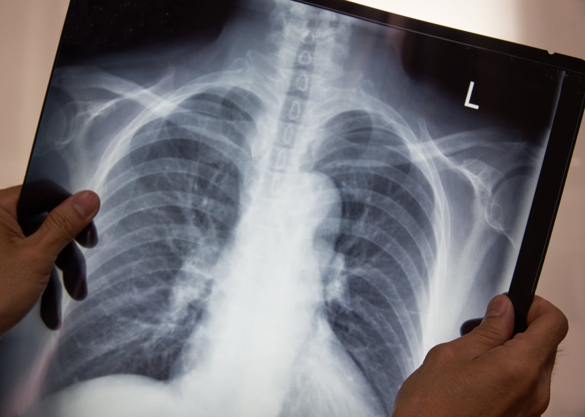 Tuberculosis en Panamá: así se enfrenta la enfermedad en  las regiones más afectadas