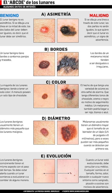 La marca inofensiva o cancerígena de un lunar