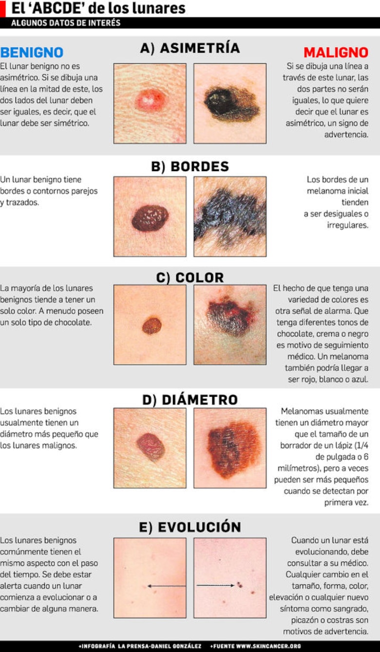 La marca inofensiva o cancerígena de un lunar