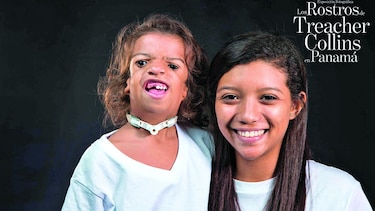 Mirada a los rostros de Treacher Collins