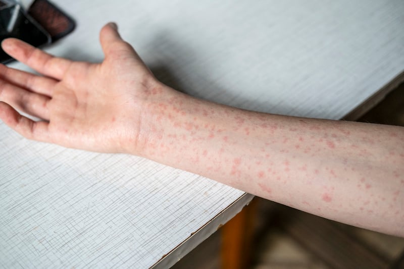 Panamá confirma dos casos importados de sarampión y refuerza vigilancia epidemiológica