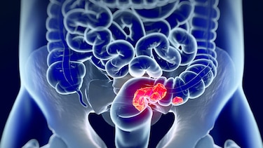 Cáncer de colon y recto tienen un ' fuerte componente hereditario'