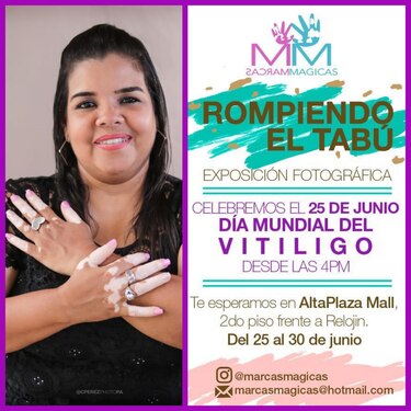 Vitiligo, una enfermedad que no debe causar vergüenza