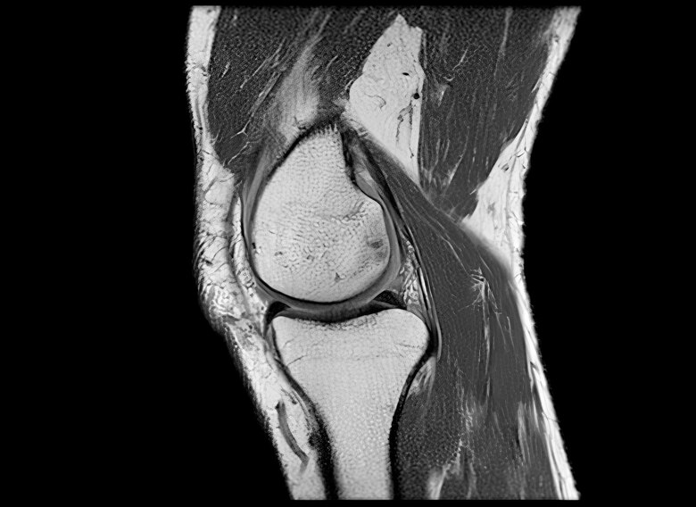 Cómo fortalecer tus rodillas para no sufrir en el futuro