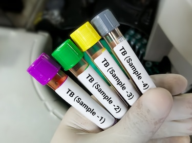 Urge que la tuberculosis se encare con más  beligerancia  