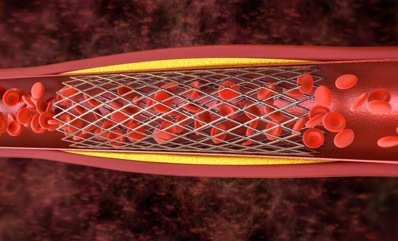 Julio Palmaz, el argentino que revolucionó la cardiología inspirado en una pieza de metal que un albañil olvidó en su casa