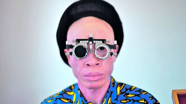 Albinos africanos sufren persecución