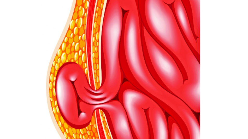 ¿Es ese bulto una hernia?