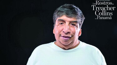 Mirada a los rostros de Treacher Collins