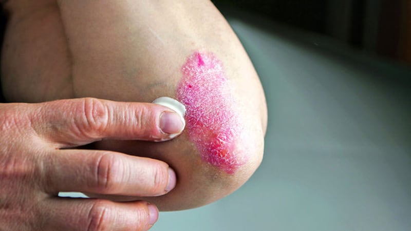 De la piel a las articulaciones, el riesgo oculto de la psoriasis