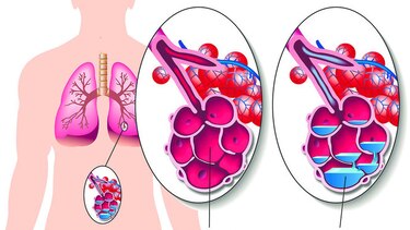 Evidencia contra el neumococo