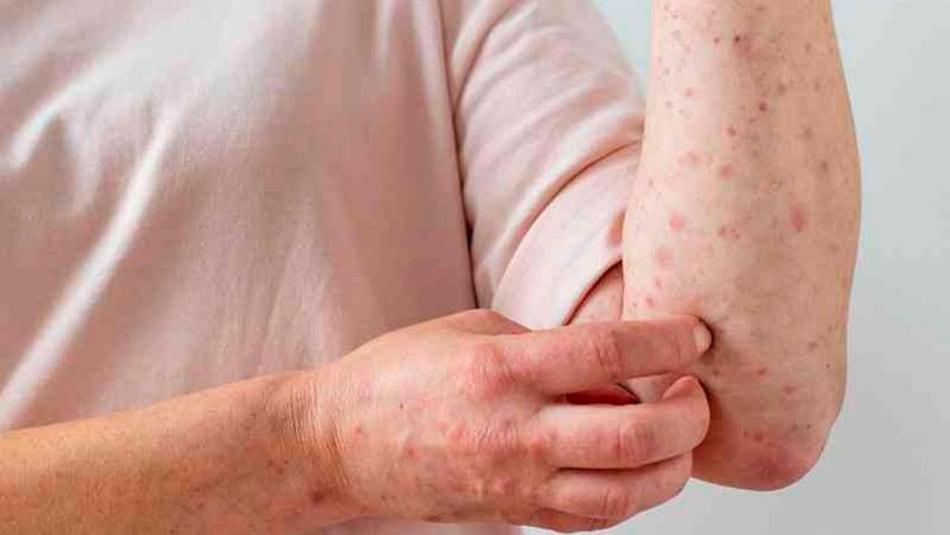 Expertos británicos presentan ensayo de tratamiento para la viruela del mono