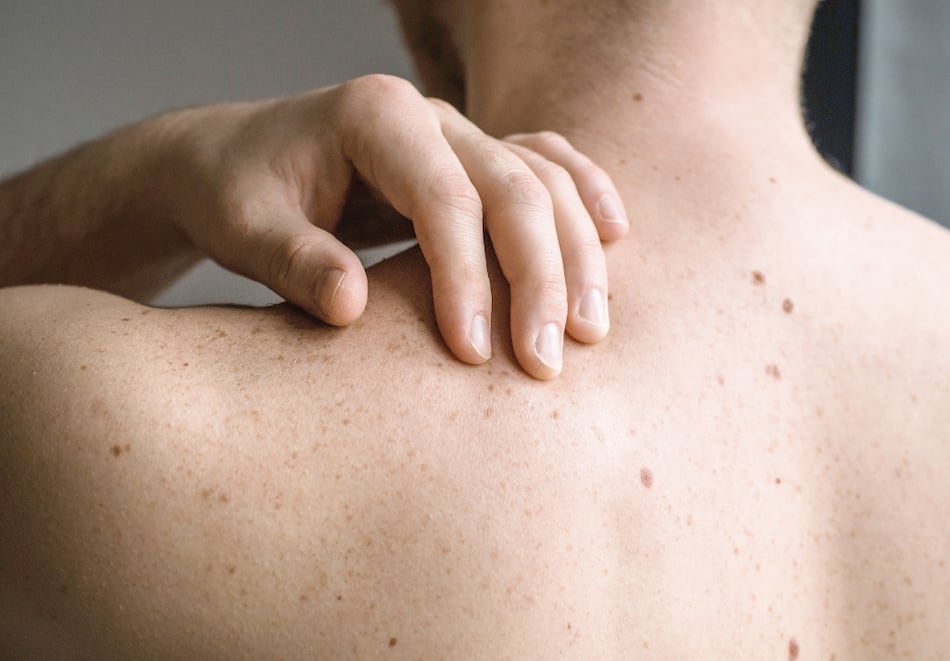 El cuidado de la piel en los pacientes de cáncer