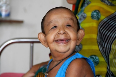 Enfermedad hace que niño bangladesí de cuatro años parezca un anciano