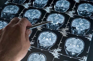 Científicos identifican una proteína clave para tratar el Alzheimer