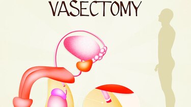 9 mitos de la vasectomía