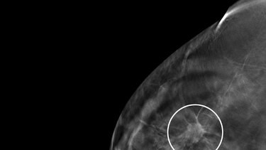 Incidencia y mortalidad por cáncer