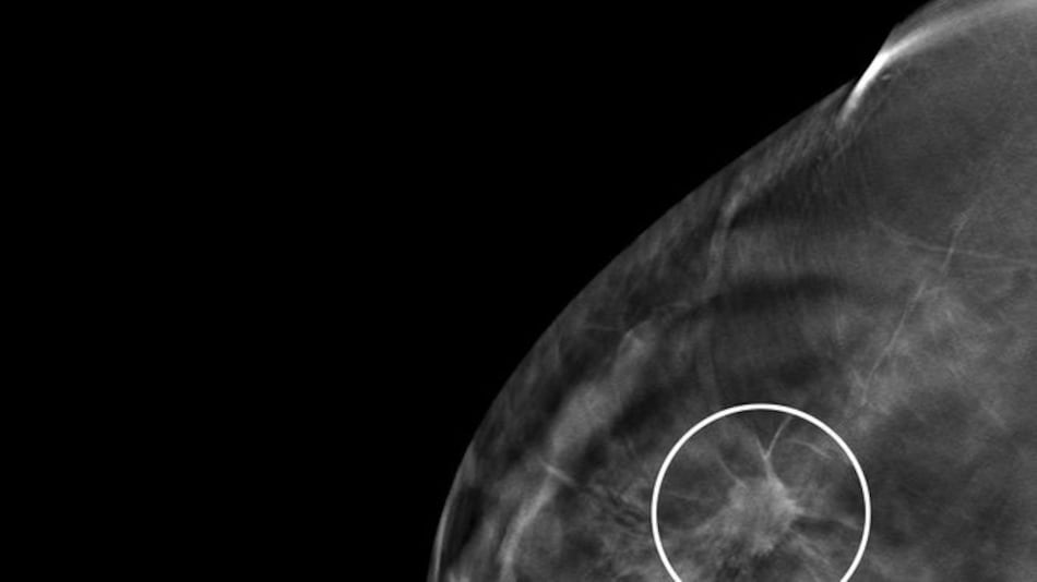 Incidencia y mortalidad por cáncer