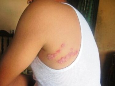 Adelantan estudio científico de leishmaniasis
