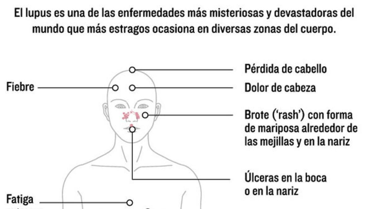 El lupus eritematoso sistémico puede afectar la piel, el cerebro y otros órganos.Tomada de ‘Color Atlas of Pediatric Dermatology’