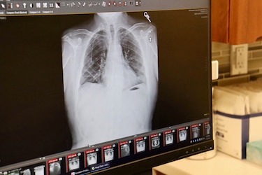 Trasplante doble de pulmón salva a hombre estadounidense con cáncer terminal
