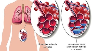 Publican nueva evidencia contra el neumococo en 'NEJM'