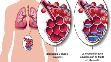 Publican nueva evidencia contra el neumococo en 'NEJM'