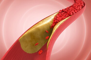 La aterosclerosis provoca un envejecimiento ‘mucho más rápido’, según estudio