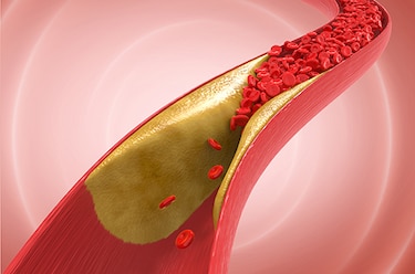 La aterosclerosis provoca un envejecimiento ‘mucho más rápido’, según estudio