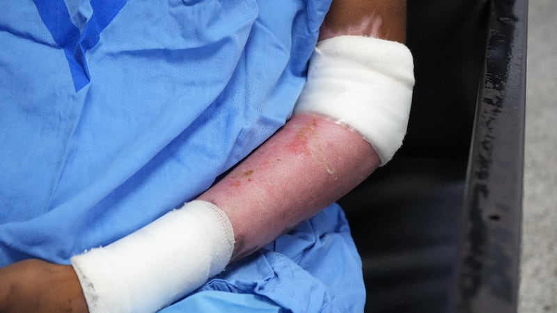 Hospital del Niño alerta por el uso de pirotecnia y pide extremar la prevención