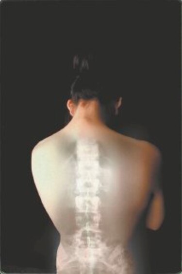 12 mitos sobre osteoporosis