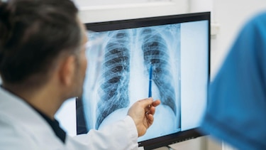 (Actualizada: 1)Qué es un adenocarcinoma pulmonar, el tipo de tumor maligno que le extirparon al papa León XIV