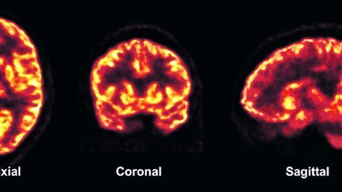 Técnica muestra comunicación entre neuronas