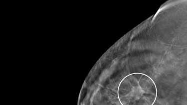 Incidencia y mortalidad por cáncer