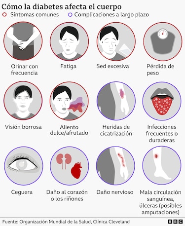 Diabetes tipo 5, la nueva y desconocida categoría de la enfermedad que divide a científicos y médicos