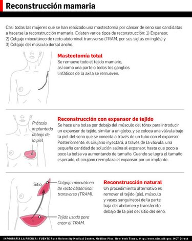 La reconstrucción mamaria, un arte que restaura la feminidad