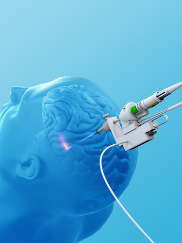 Nuevo método láser para tumores cerebrales y epilepsia inoperables