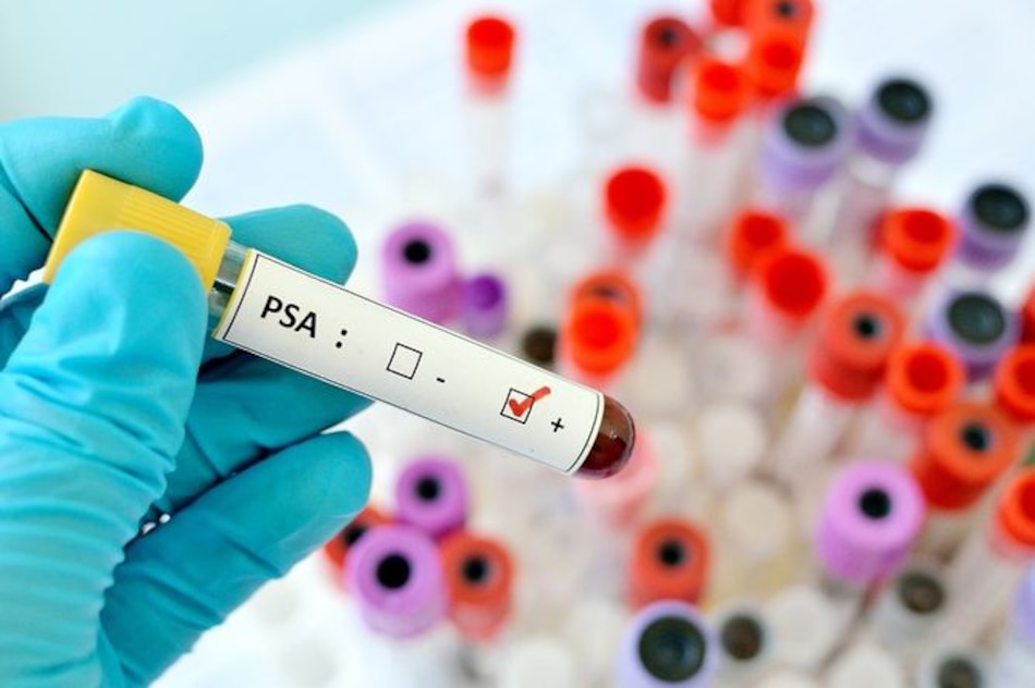 Cinco mitos del cáncer de próstata