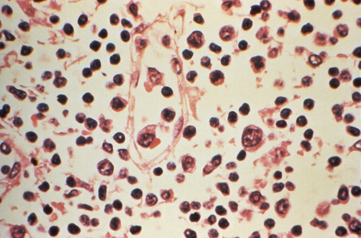 Hantavirus y covid-19 no son iguales y expertos descartan otra pandemia