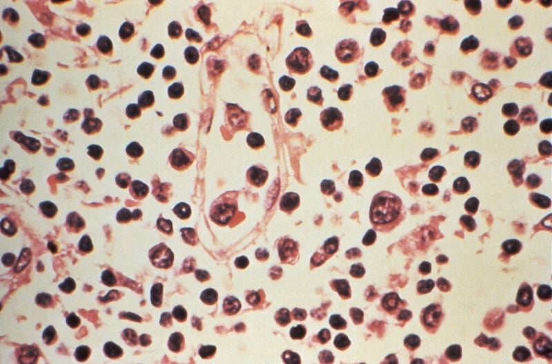 Hantavirus y covid-19 no son iguales: expertos descartan otra pandemia 
