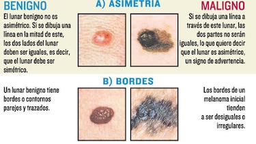 ¿Cuándo un lunar es inofensivo?